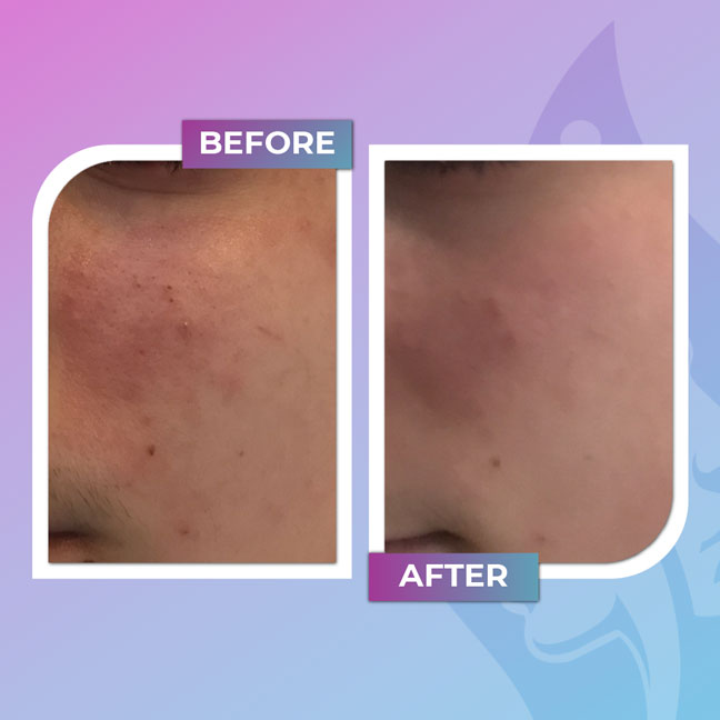 Before and after facial treatment for cheek texture and clarity