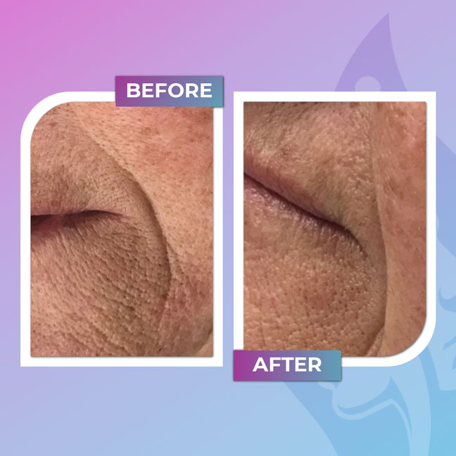 Before and after smoothing treatment around the mouth