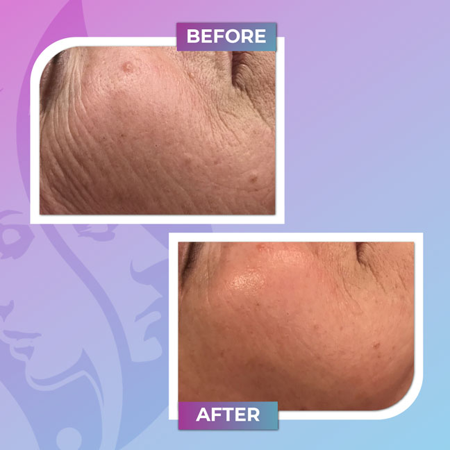 Before and after skin texture treatment on the chin
