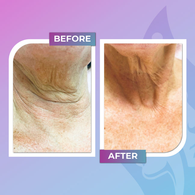 Before and after neck skin texture and firmness treatment
