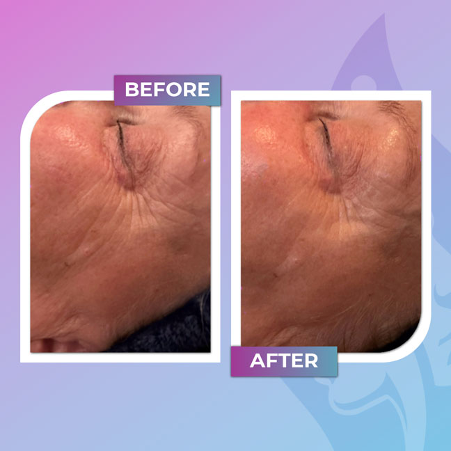 Before and after wrinkle-smoothing treatment near the eye