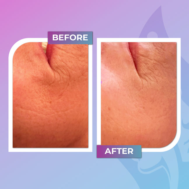 Before and after skin texture treatment on the chin and neck