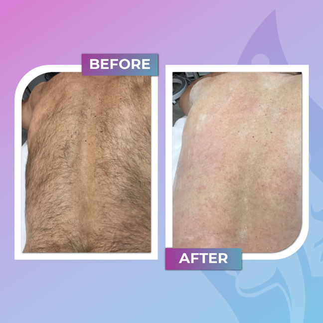 Before and after back waxing hair removal
