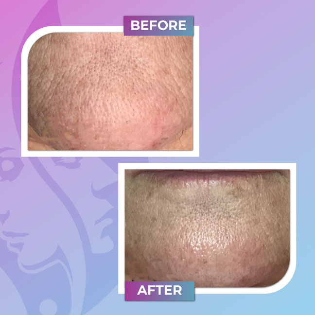 Before and after forehead skin texture and pore treatment