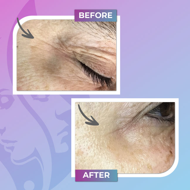 Before and after treatment for under-eye fine lines