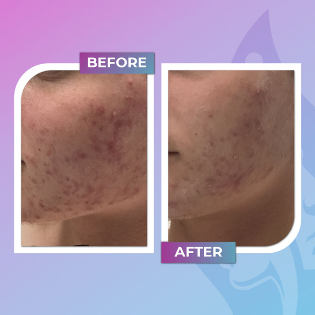 Before and after acne treatment on the cheek